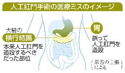 人工肛門手術の医療ミスのイメージ